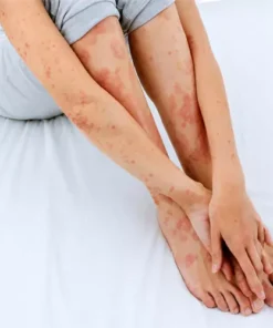 Ayurvedic Treatment For Eczema And Psoriasis