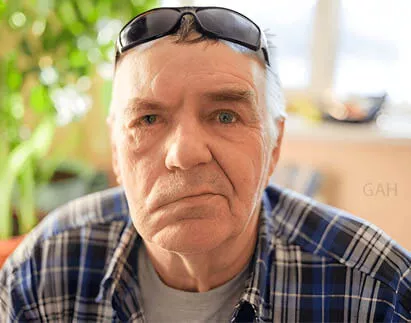 Ayurvedic Treatment For Facial Palsy