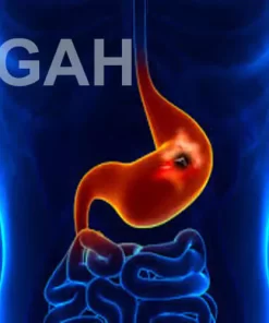 Gastric And Duodenal Ulcer