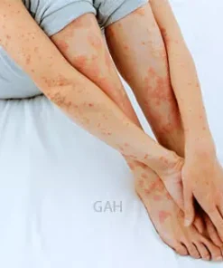 Ayurvedic Treatment For Eczema And Psoriasis