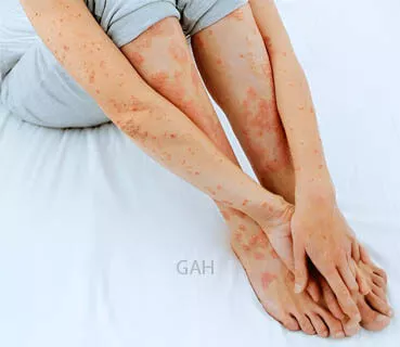 Ayurvedic Treatment For Eczema And Psoriasis