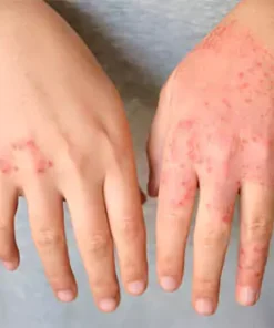 Eczema