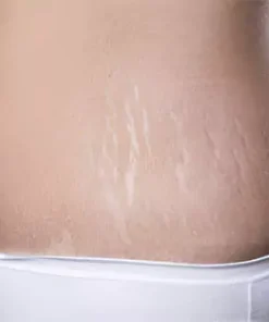 Stretch Marks