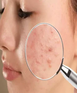 Acne Pimples